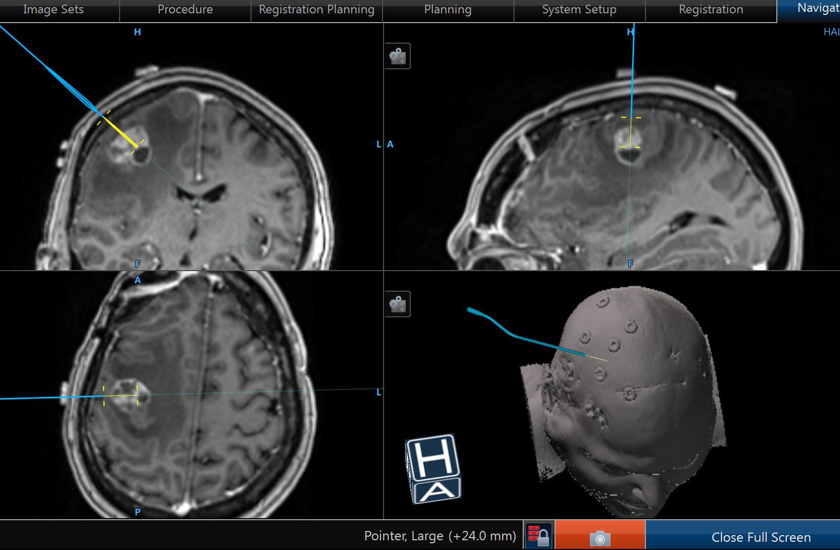 3-D Exoscope For Brain Tumor Surgery